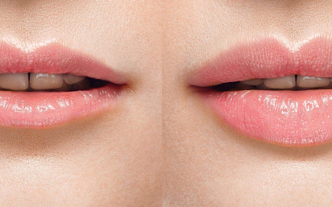 What are the Benefits of Having Dermal Lip Fillers?