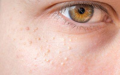Treating Skin Tags, Blood Spots or Milia