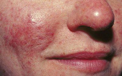 Skin Troubles – Is It Acne Or Rosacea?