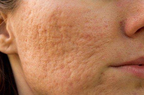 Top Treatments for Acne Scarring