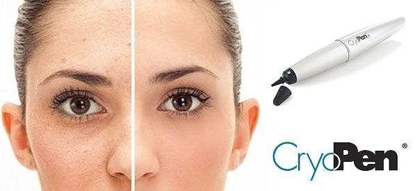 Ease your Skin Pigmentation- CryoPen Treatment