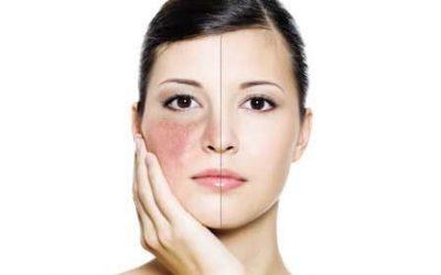 Milia Skin Condition- Causes and Treatment