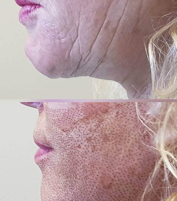 Cheeks and Jowls – Remarkable Results using Plasma Pen