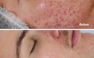 Best Place for Acne Treatments