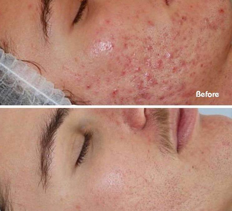 Best Place for Acne Treatments