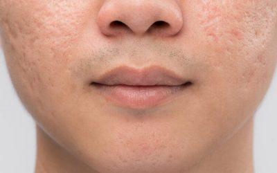 How Best to Treat Acne Scaring