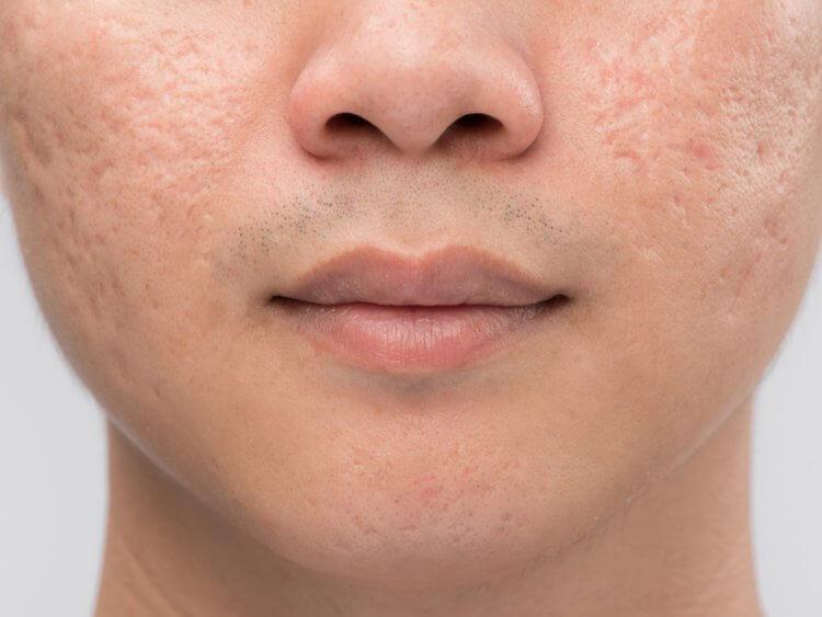 How Best to Treat Acne Scaring