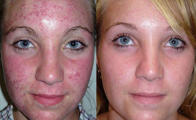Acne Scarring Causes and Cures