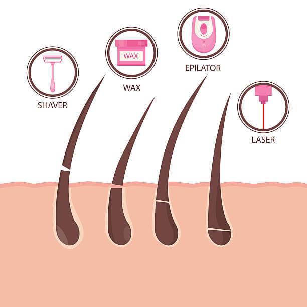 7 Things to Know Before Getting Laser Hair Removal - BeauSynergy