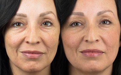 What is the Best Skin Tightening Treatment at Home?