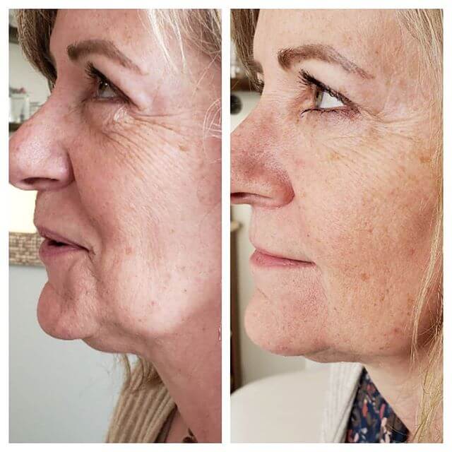 Fibroblast Plasma Skin Tightening