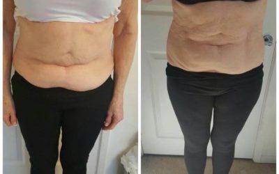 Body Contouring with Fat Freezing At BeauSynergy
