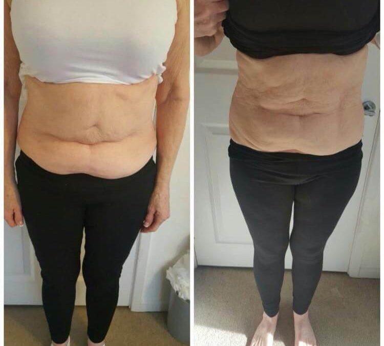 Body Contouring with Fat Freezing At BeauSynergy