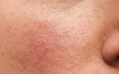 Beat Rosacea Symptoms with Great Skin Care Hatfield