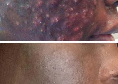 Acne Scaring Before and After 3