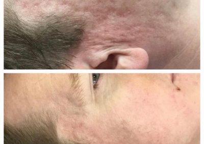 Acne Scaring Treatment