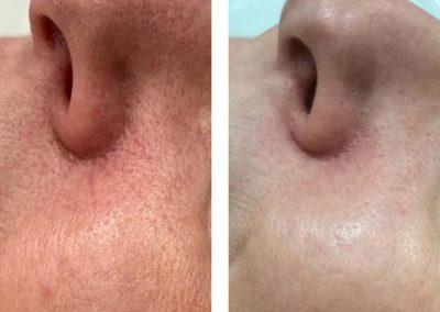 Thread Vein removal with Thermavein around the nose 2