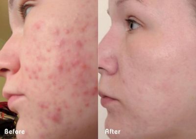 dawn acne before and after