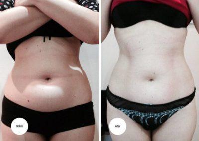 offers on fat freezing fat reduction 768x552 1