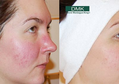 rosacea before and after 2