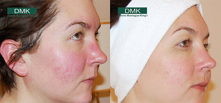 Rosacea before and after