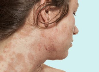 How to Resolve the Skin Issues Caused by Eczema