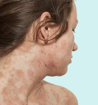 How to Resolve the Skin Issues Caused by Eczema