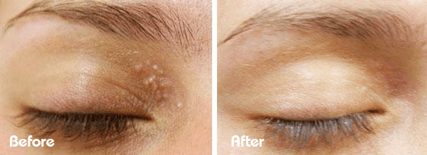 Milia removal before and after