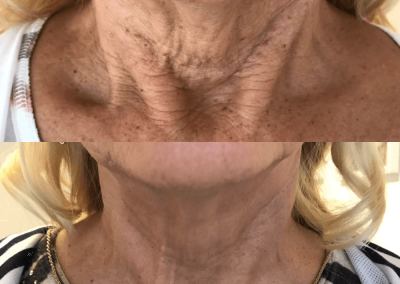 Saggy Crepey neck treatment 1