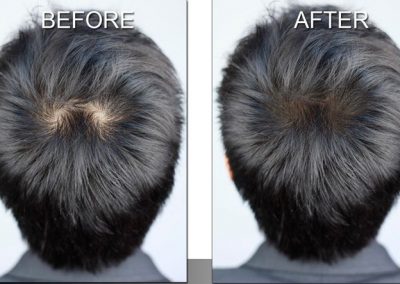 Scalp micropigmentation before and after