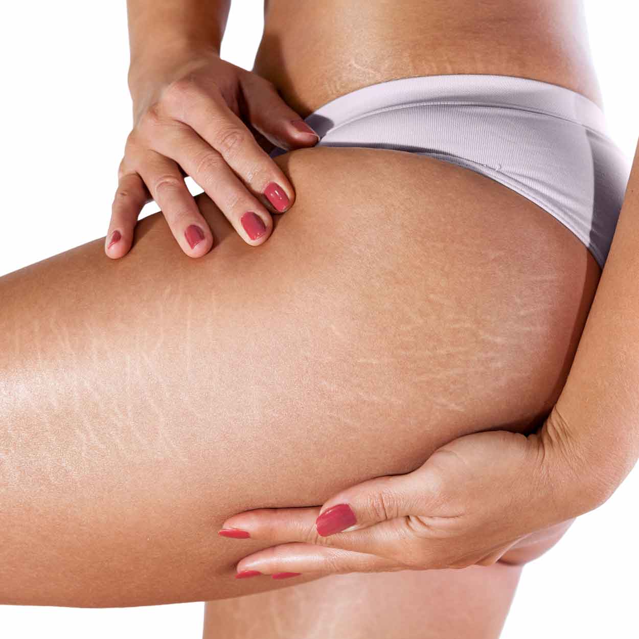Stretch marks with microneedling