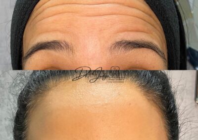 Botox lines on forehead before and after 2