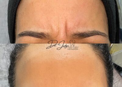 Botox. Line between eyes. Vertical 11 before and after