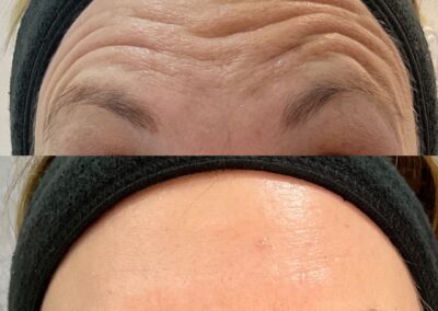 Botox. Lines on forehead before and after