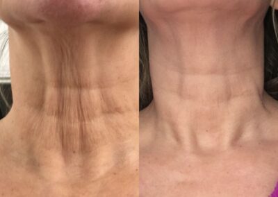 Crepey neck saggy neck treatment to go top left