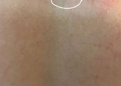 CryoPen Sun Damage Age Spot removal on scalp head after