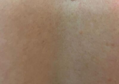 CryoPen Sun Damage Age Spot removal on scalp head before