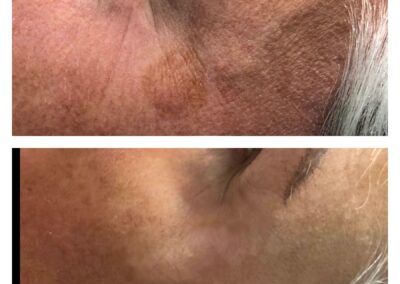 CryoPen for Pigmentation before and after