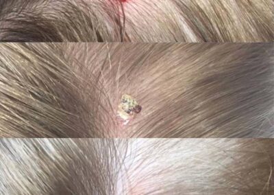 CryoPen for Skin Tag on scalp head 1 1