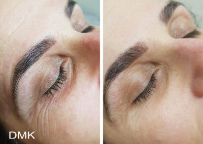 DMK crows feet fine lines and wrinkles