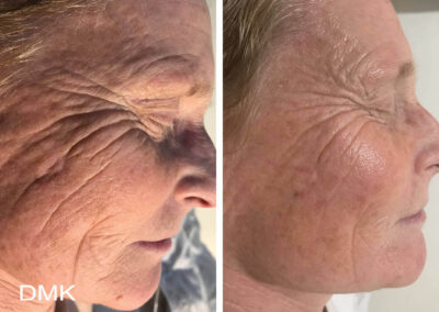 DMK fine lines and wrinkles