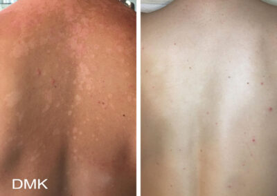DMK pigmentation and sun damage on back