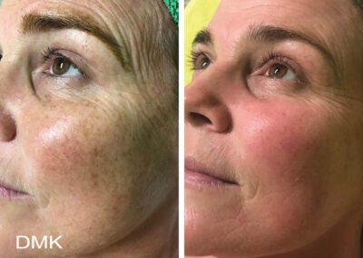 DMK pigmentation and sun damage on face