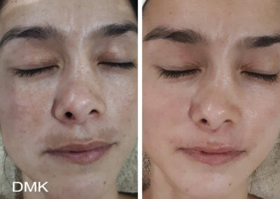 DMK pigmentation face and lip