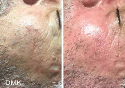 DMK pigmentation on mans face