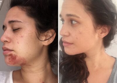 Dermalux before and after 1