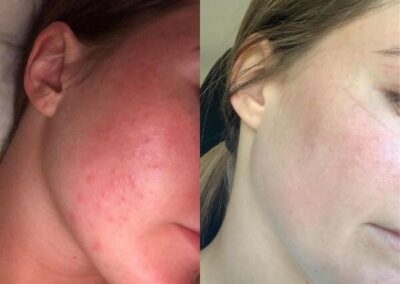 Dermalux before and after 4