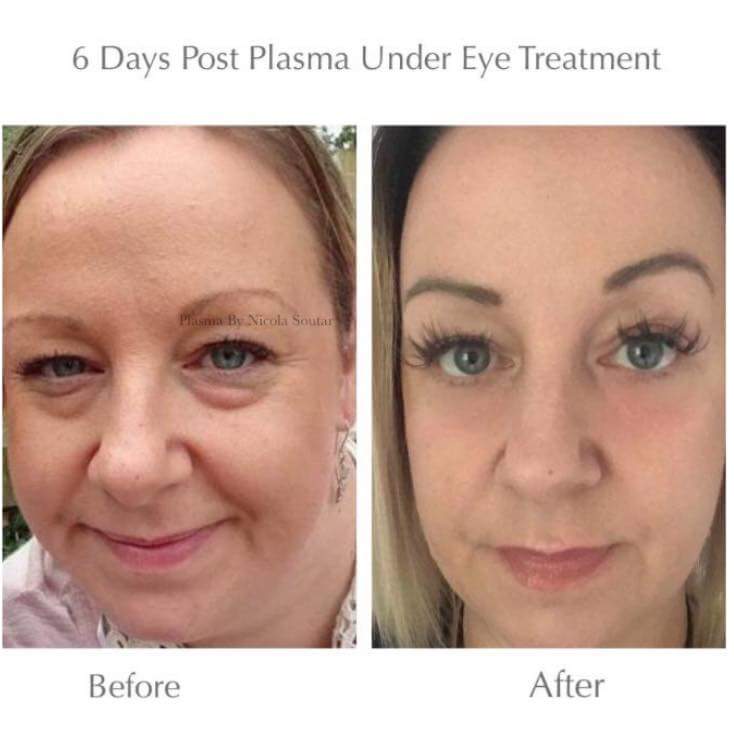 nationalism leave pale Non-Surgical Eyebag Removal | Blepharoplasty | Herts | BeauSynergy