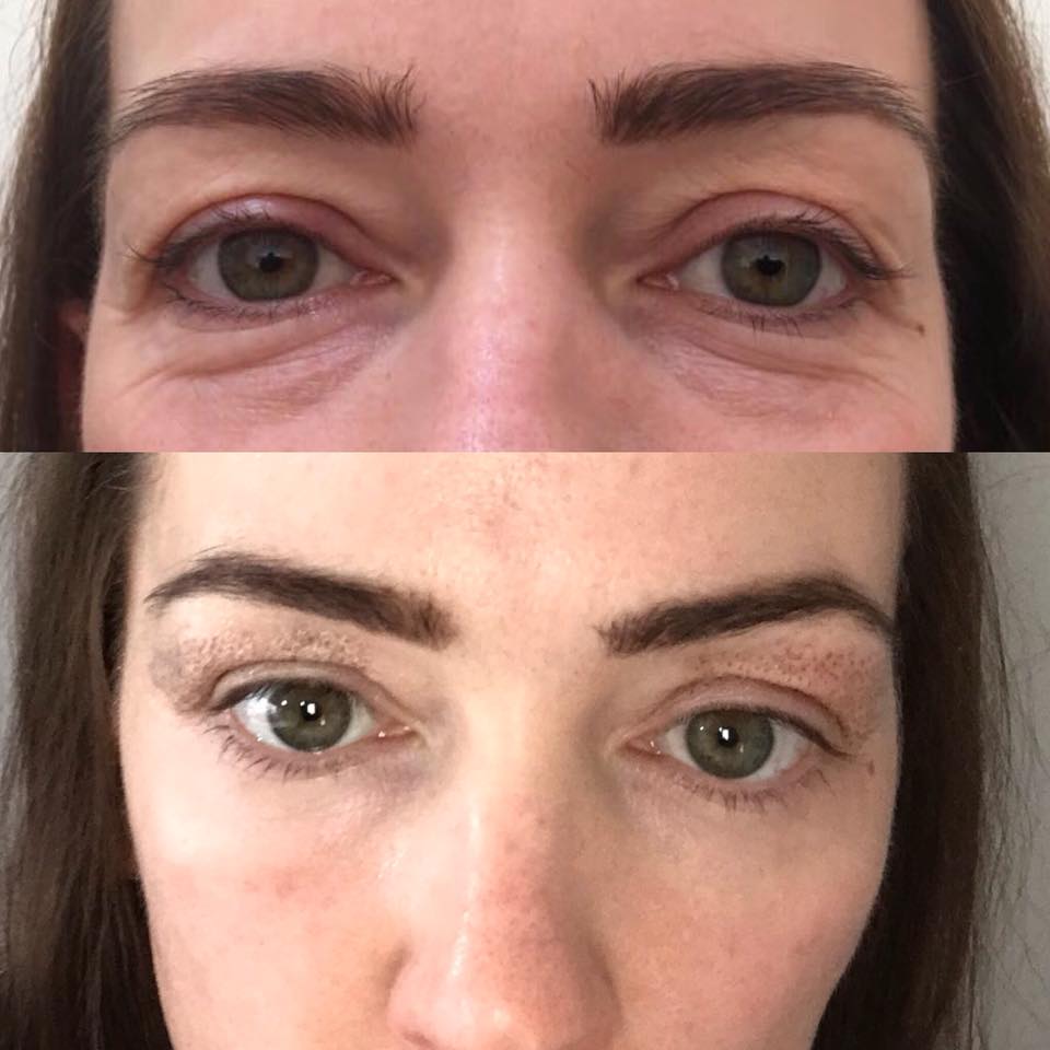 Eyebags treatment before and after