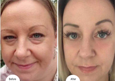 Eyelid lift plasma pen before and after